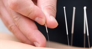 Acupuncture Treatment Offering Myriad Health Benefits